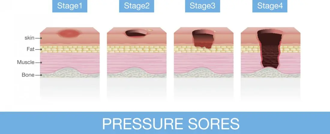 Cross-section diagram showing the four stages of pressure ulcer progression through skin, fat, muscle, and bone tissue layers